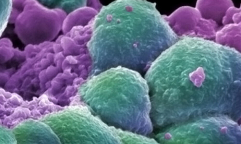 Breast cancer cells
