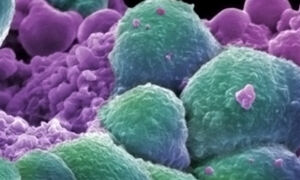 Breast cancer cells
