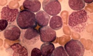 Leukaemia study by Papaemmanuil and Gerstung reveals AML is 11 different 
diseases

