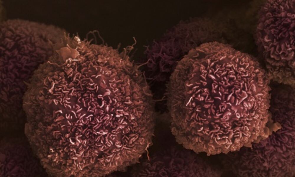 Pancreatic cancer cells: one of 43 types of cancer studied by the Wellcome 
Sanger Institute for gene fusions. Image credit: Anne Weston, Francis Crick 
Institute
